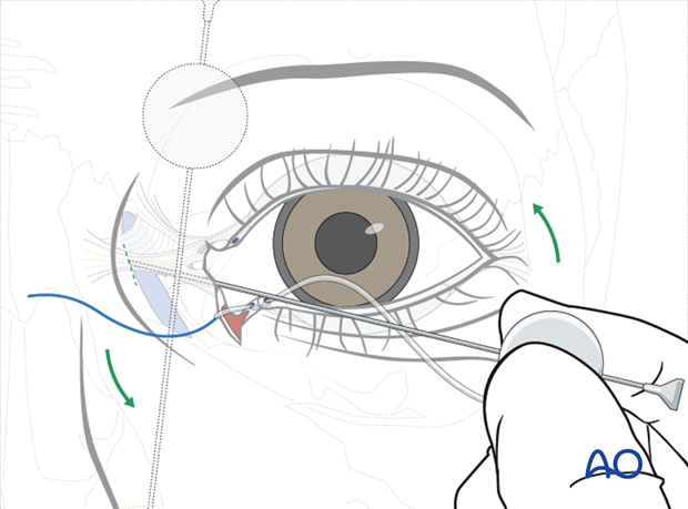 Repair of periorbital soft-tissue injuries and lacrimal system in NOE injuries