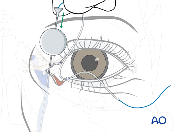 Repair of periorbital soft-tissue injuries and lacrimal system in NOE injuries