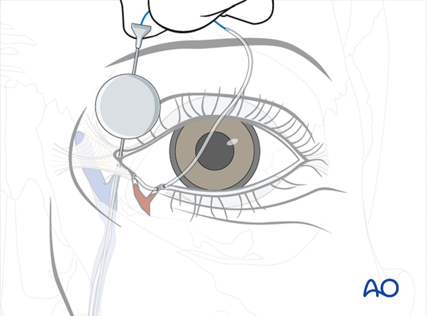 Repair of periorbital soft-tissue injuries and lacrimal system in NOE injuries