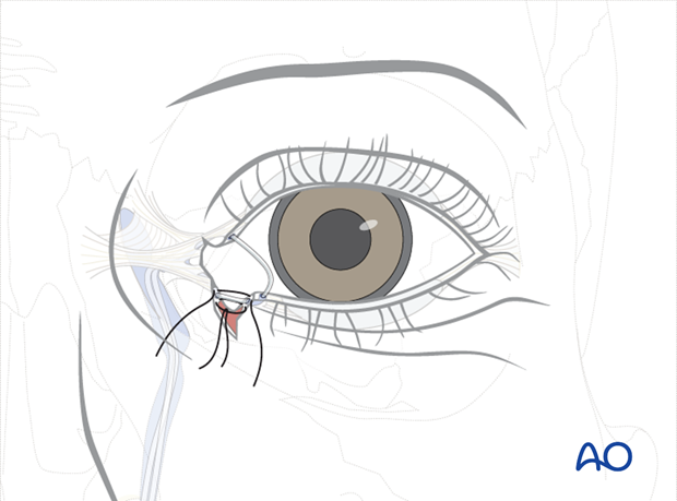 Repair of periorbital soft-tissue injuries and lacrimal system in NOE injuries