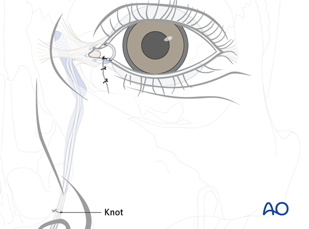 Repair of periorbital soft-tissue injuries and lacrimal system in NOE injuries