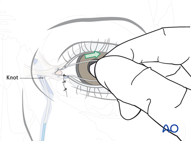 Repair of periorbital soft-tissue injuries and lacrimal system in NOE injuries