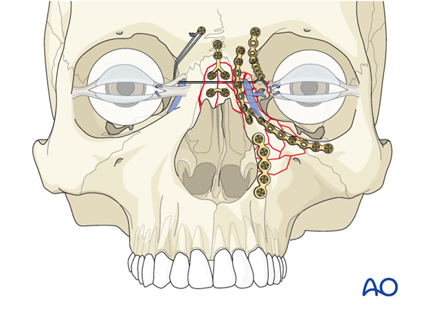 Repair of periorbital soft-tissue injuries and lacrimal system in NOE injuries