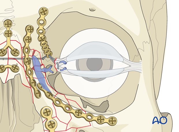 Repair of periorbital soft-tissue injuries and lacrimal system in NOE injuries