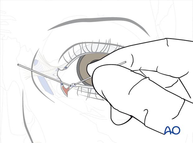 Repair of periorbital soft-tissue injuries and lacrimal system in NOE injuries