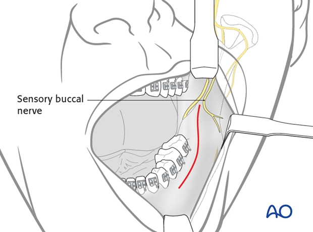 transoral approach to the mandibular angle