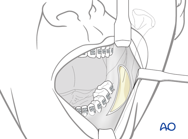 transoral approach to the mandibular angle