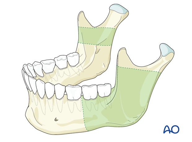 transoral approach to the mandibular angle