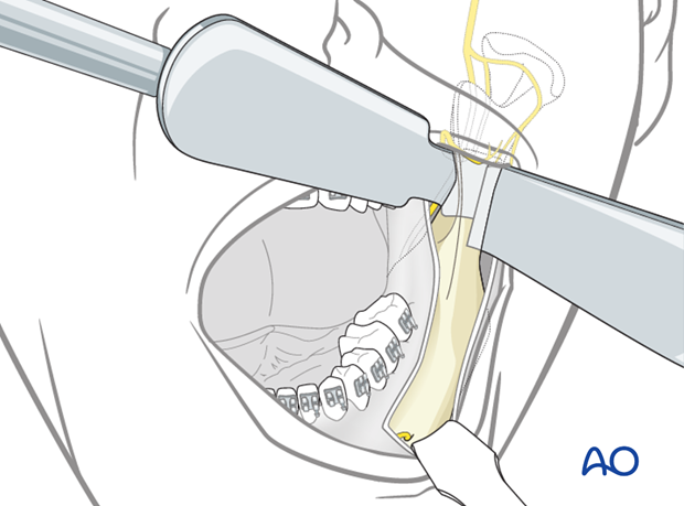 transoral approach to the mandibular angle