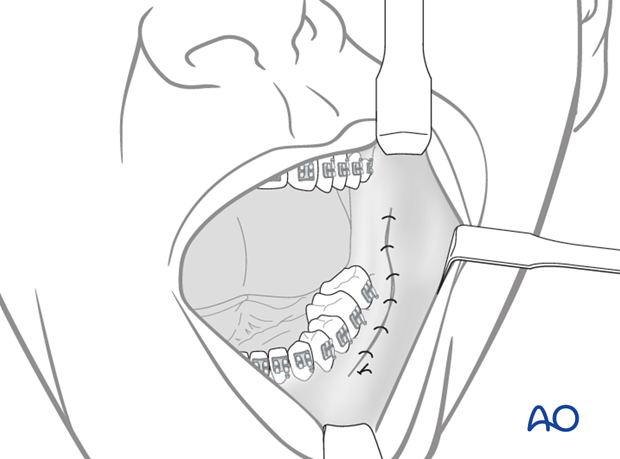 transoral approach to the mandibular angle