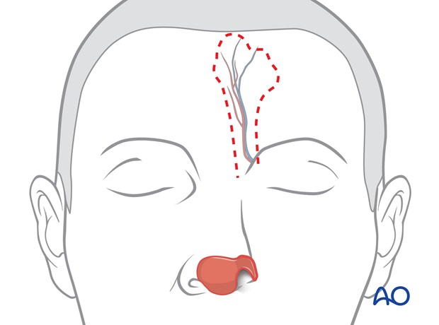 Nose Reconstruction by Dr. Frederick J Menick