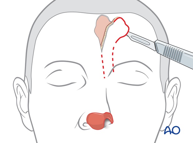 Nose Reconstruction by Dr. Frederick J Menick