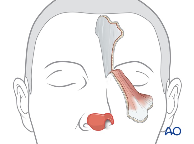 Nose Reconstruction by Dr. Frederick J Menick