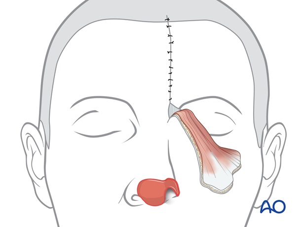 Nose Reconstruction by Dr. Frederick J Menick