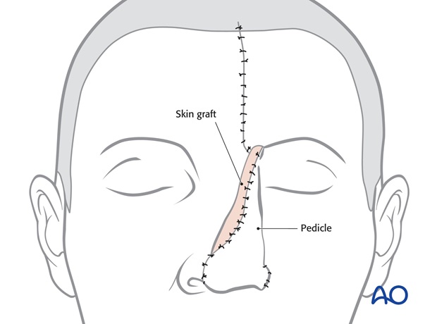 Nose Reconstruction by Dr. Frederick J Menick