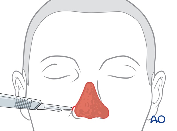 Nose Reconstruction by Dr. Frederick J Menick