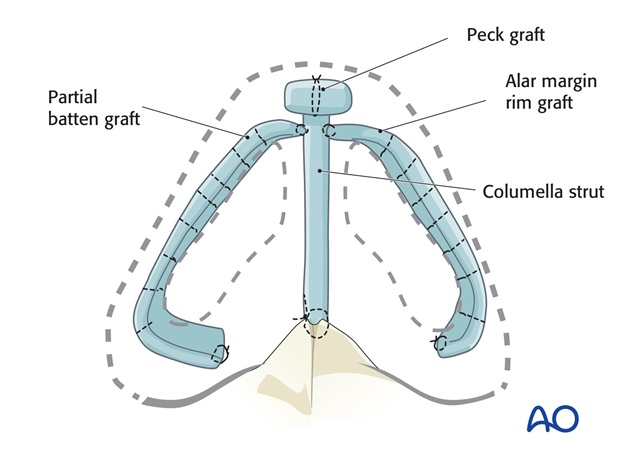 Nose Reconstruction by Dr. Frederick J Menick