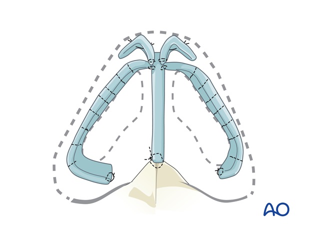 Nose Reconstruction by Dr. Frederick J Menick