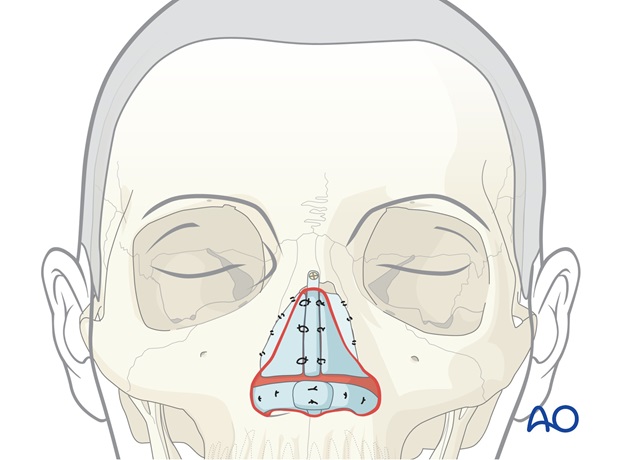 Nose Reconstruction by Dr. Frederick J Menick