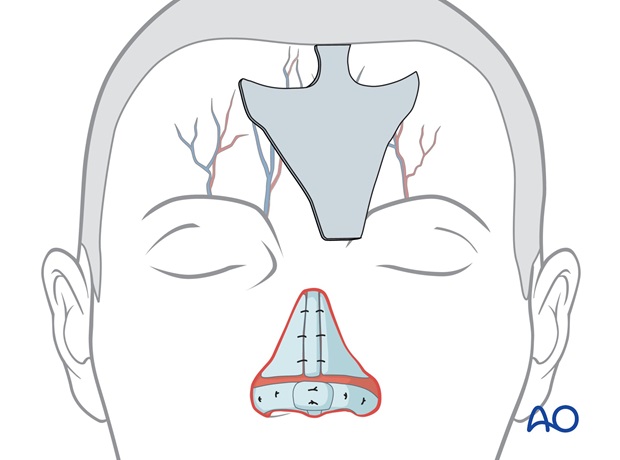 Nose Reconstruction by Dr. Frederick J Menick