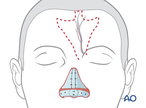 Nose Reconstruction by Dr. Frederick J Menick