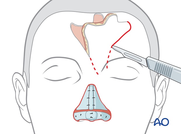 Nose Reconstruction by Dr. Frederick J Menick