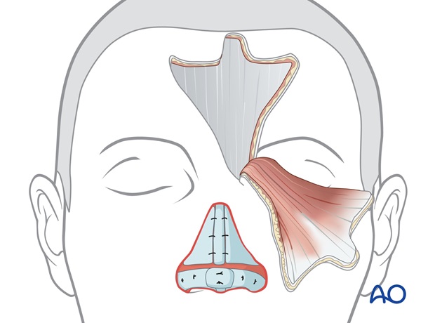 Nose Reconstruction by Dr. Frederick J Menick