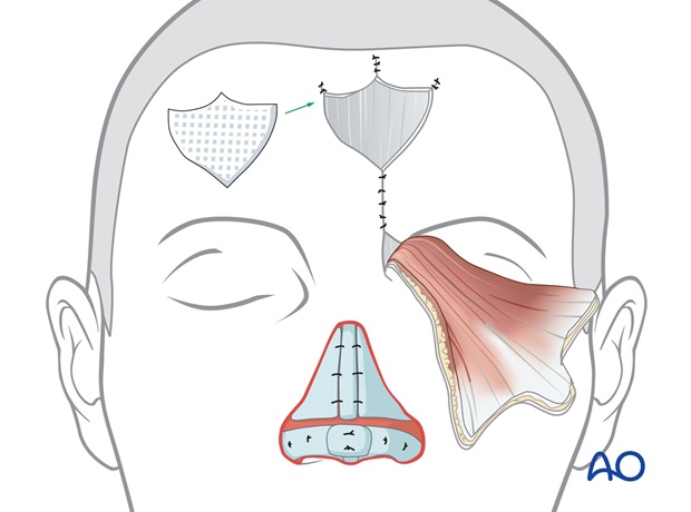 Nose Reconstruction by Dr. Frederick J Menick