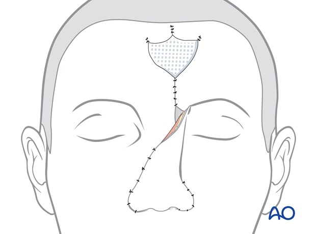 Nose Reconstruction by Dr. Frederick J Menick