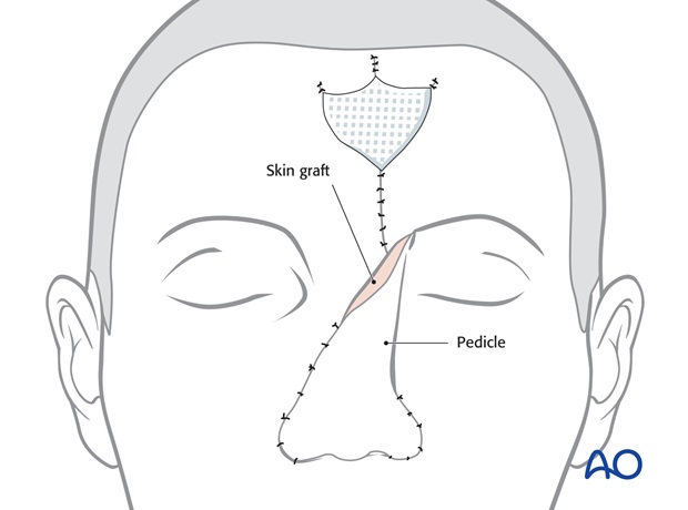 Nose Reconstruction by Dr. Frederick J Menick