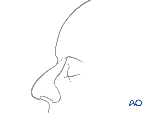 Nose Reconstruction by Dr. Frederick J Menick