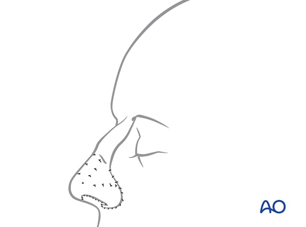 Nose Reconstruction by Dr. Frederick J Menick