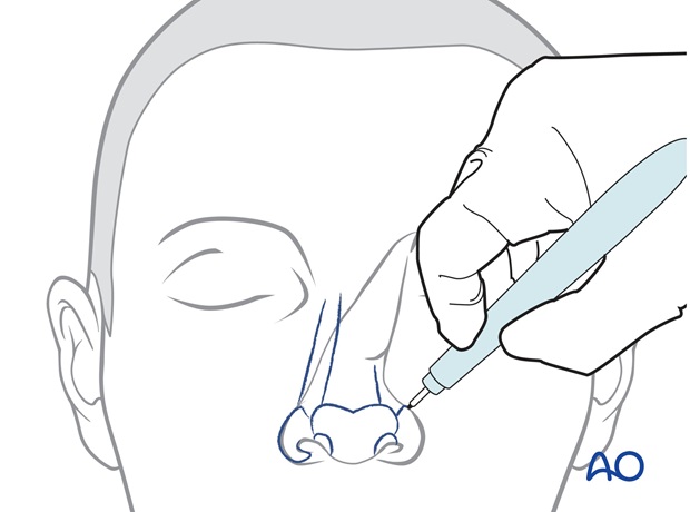 Nose Reconstruction by Dr. Frederick J Menick