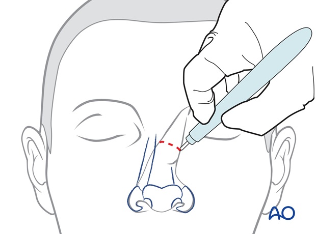 Nose Reconstruction by Dr. Frederick J Menick