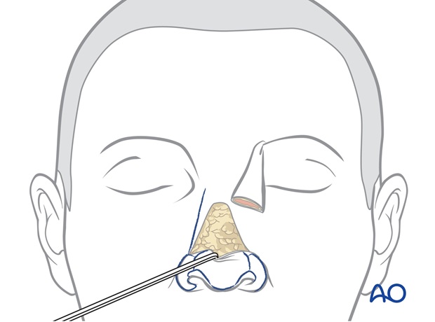 Nose Reconstruction by Dr. Frederick J Menick