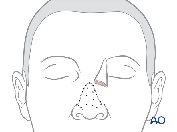 Nose Reconstruction by Dr. Frederick J Menick