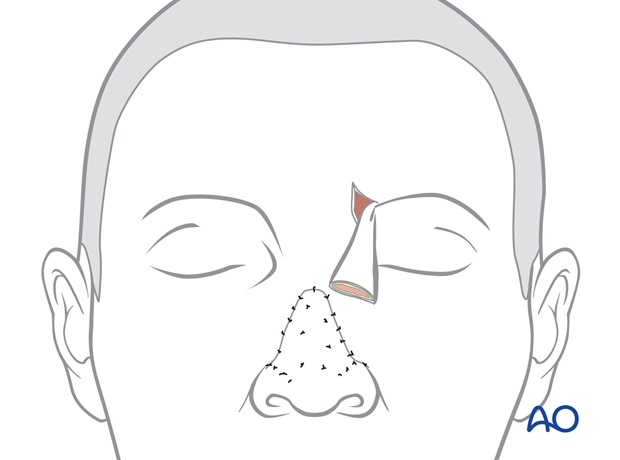 Nose Reconstruction by Dr. Frederick J Menick