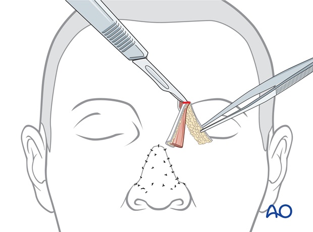 Nose Reconstruction by Dr. Frederick J Menick