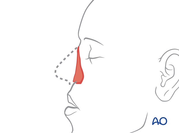 Nose Reconstruction by Dr. Frederick J Menick