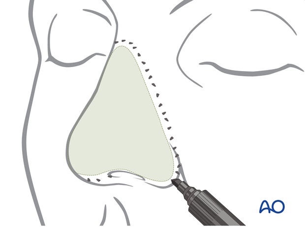 Nose Reconstruction by Dr. Frederick J Menick