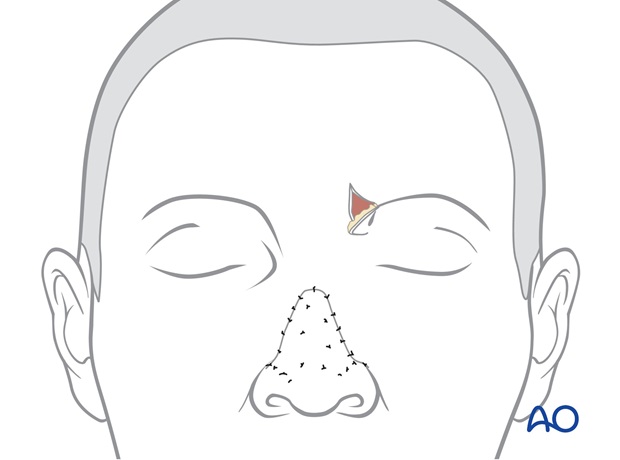 Nose Reconstruction by Dr. Frederick J Menick