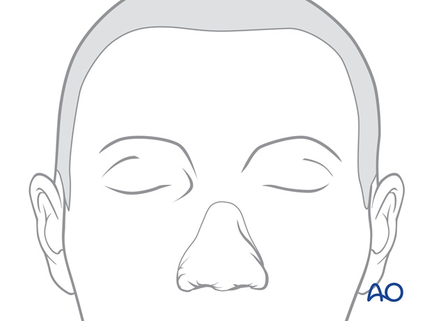 Nose Reconstruction by Dr. Frederick J Menick