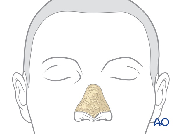 Nose Reconstruction by Dr. Frederick J Menick