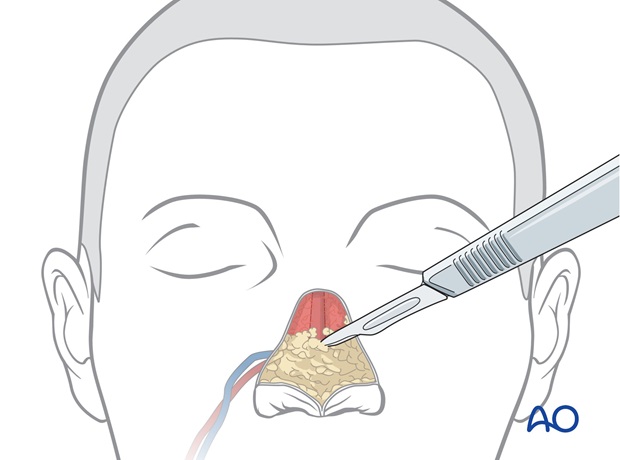 Nose Reconstruction by Dr. Frederick J Menick