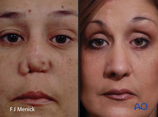 Nose Reconstruction by Dr. Frederick J Menick