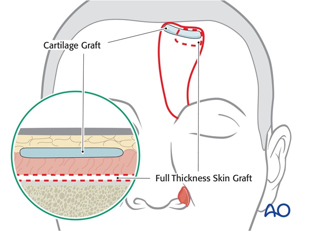 Nose Reconstruction by Dr. Frederick J Menick