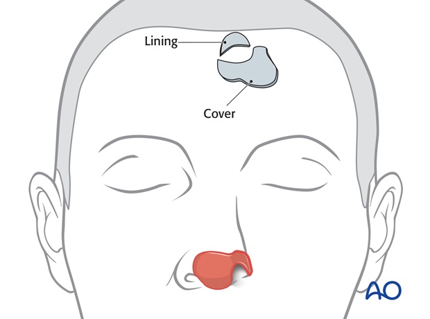 Nose Reconstruction by Dr. Frederick J Menick