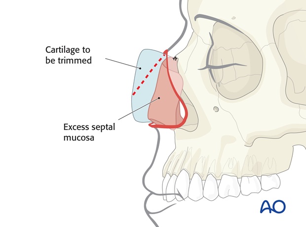 Nose Reconstruction by Dr. Frederick J Menick