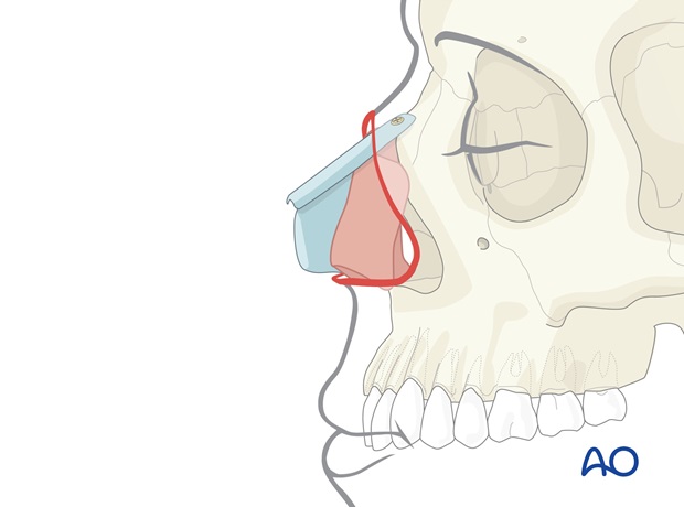 Nose Reconstruction by Dr. Frederick J Menick