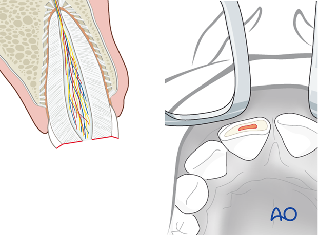 Partial pulp amputation (pulpotomy)